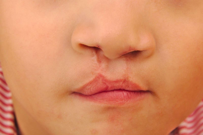 唇腭裂和软腭裂一样吗腭裂的修复方法有哪些
